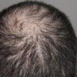 stress and hair loss